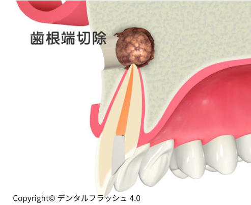 歯根嚢胞手術