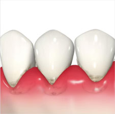歯茎が赤く腫れているイラスト2